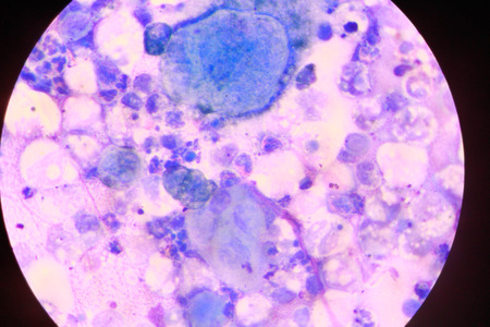 multinucleated giantの写真素材