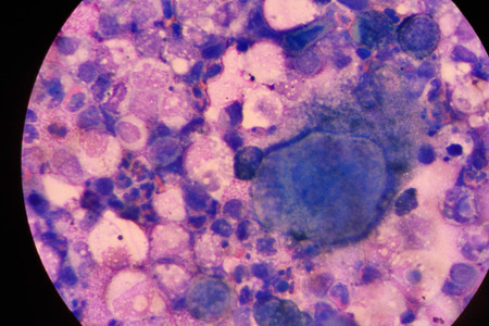 multinucleated giantの写真素材