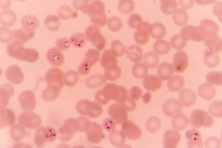plasmodium falciparum ring form state , multiple in fection of red blood cellsの写真素材