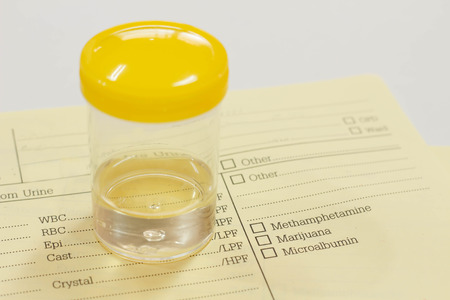 Urine sample  in laboratoryの写真素材