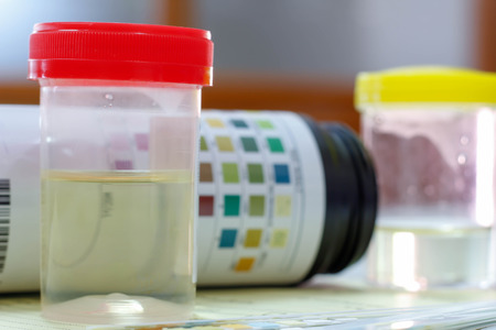 Urine sample with reagent strip test urinalysis in laboratory