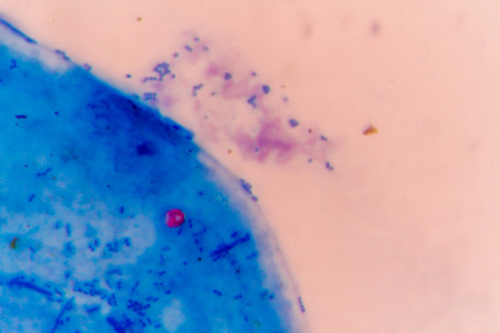 stool specimen shows Cryptosporidium eggs in red. They can cause diarrhea and more serious problems in children and adults who immune systems are suppressed.の写真素材
