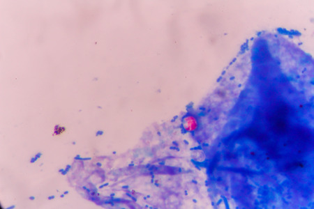 stool specimen shows Cryptosporidium eggs in red. They can cause diarrhea and more serious problems...