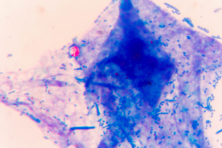 stool specimen shows Cryptosporidium eggs in red. They can cause diarrhea and more serious problems in children and adults who immune systems are suppressed.の写真素材