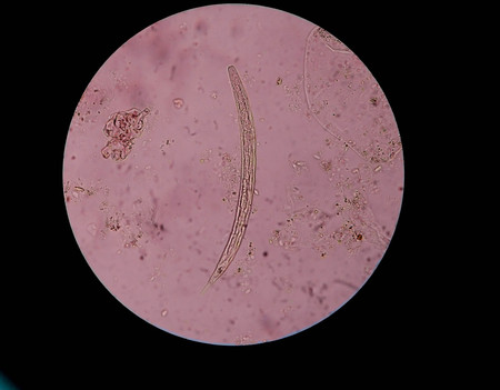 Parasite Strongyloides stercoralis in stool under microscopy
