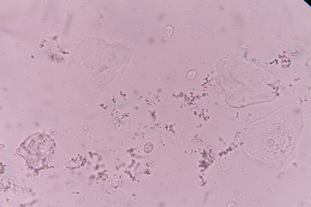 Epithelial Cells with bacterial in urineの写真素材