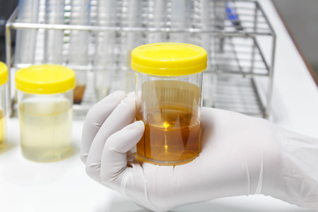 Urine sample