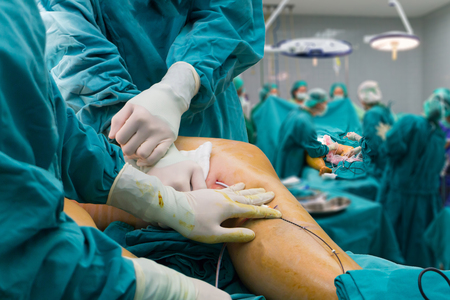 Doctor surgery foot Suture,Percutaneous transluminal angioplasty ,Vascular bypass graft surgery ,leg ,Blur medical devices Operating Room in hospitalの写真素材