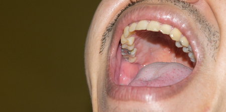 Dental cavities, bad teeth yellow teeth broken fillings.の写真素材