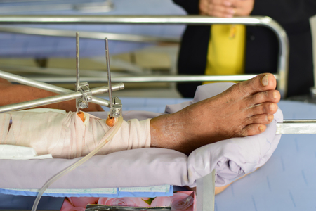 Orthopedic treatment Bone surgery of patients Steel boneの写真素材