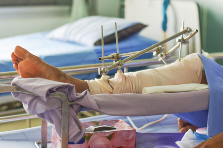 Orthopedic treatment Bone surgery of patients Steel boneの写真素材