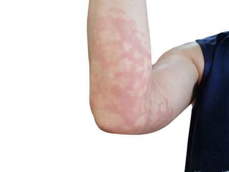 red rash on arm allergic reaction white backgroundの写真素材