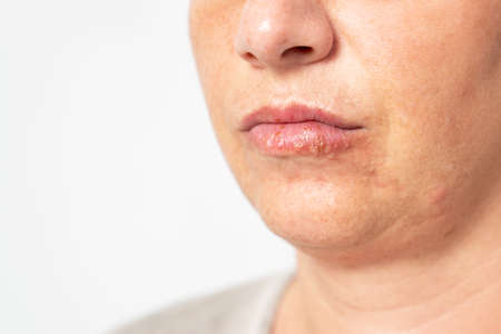 Young woman suffering from herpes on her lips. Concept skin problem, allergy and dermatology. High...
