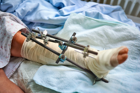 Broken ankle - orthopedicsの写真素材