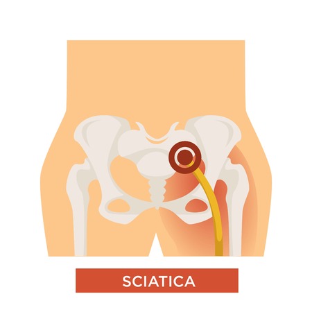 Sciatic back pain sciatica hip bone disease skeletal system inflammation vector human body part anatomy medicine and treatment trauma or injury vertebral ache and discomfort isolated skeleton bottom.のイラスト素材