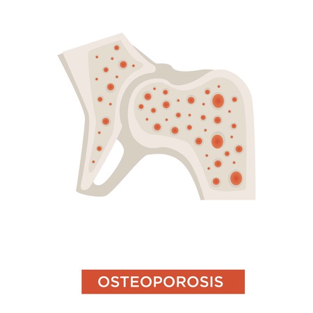 Skeleton disease osteoporosis bone structure vector calcium deficit marrow inflammation internal skeletal tissue destruction medicine and treatment or healthcare pain and ache isolated body partのイラスト素材