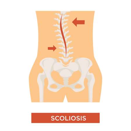 Spine curvature scoliosis disease skeleton illness vector human backbone structure disorder pain and discomfort healthcare and medical treatment backache and posture alignment isolated body partのイラスト素材