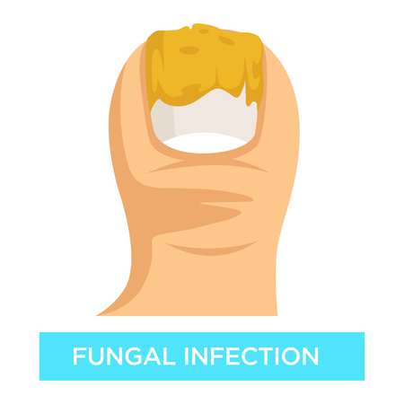 Toenail suppuration fungal infection toe damage vector nail removal disease or illness isolated body part medicine and treatment fungus medication and healthcare beauty or cosmetology problem.のイラスト素材