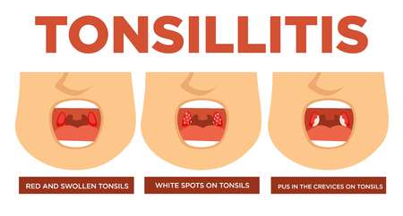 Red and swollen tonsils white spots pus in crevices vector tonsillitis open mouth disease or illness stages cold and fever with cough medicine and medical treatment healthcare and recovery symptoms.のイラスト素材