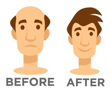 Before and after effect hair transplantation bald man and guy with hairstyle vector isolated character head baldness problem solving surgery male beauty hairdo fue and fut technologies treatment.のイラスト素材