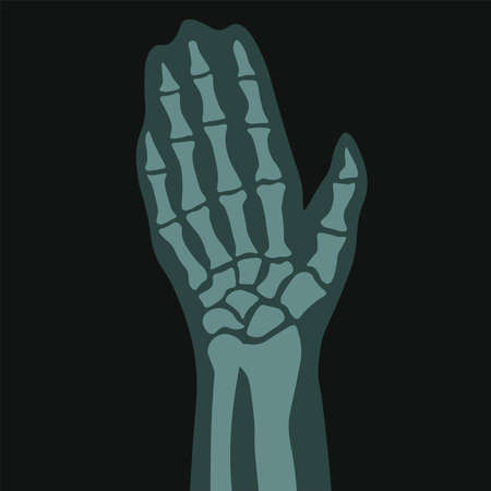 Xray of hand, palm with fingers, roentgen scanのイラスト素材