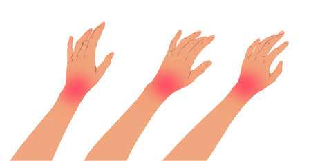 Left hands with carpal tunnel syndromeのイラスト素材