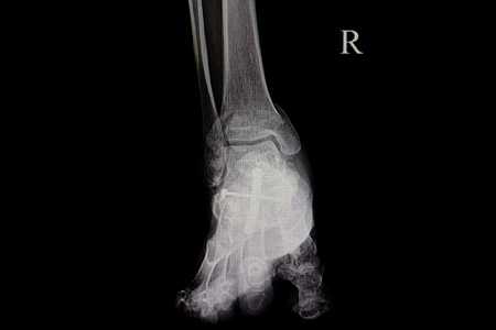 diagnostic xray film of human footの写真素材