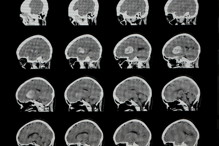 Brain computer tomography (CT) scan of a patient with large intracranial hemorrhage (hemorrhagic...