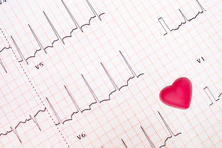 an abnormal electrocardiogram tracing (lateral wall ischemia)  and a red heart-shaped object, heart disease concept, medical background, medical educationの写真素材