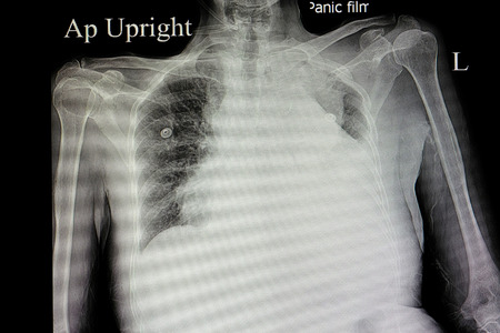 xray film of a patient with massive left pleural effusion, atelectatic lung and cardiomegalyの写真素材