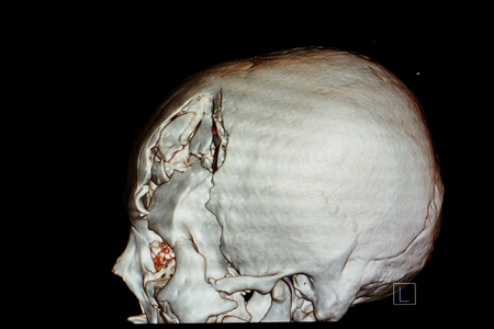 3-D rendering image of a patient skull with traumatic brain injury showing compression fracture of left temperoparietal bone, fracture of left orbital rim and left zygomatic fracture.の写真素材