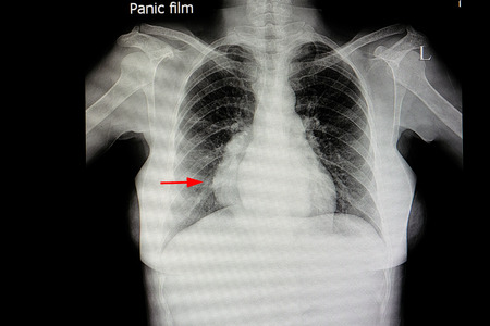 xray film of a patient with large posterior mediastinal lung mass (red arrow)の写真素材