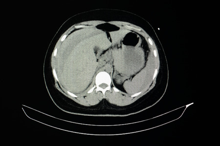 computer tomography scan of a tramatic patient with liver laceration and hemoperitonimの写真素材