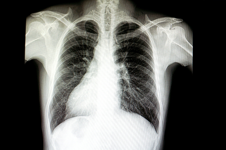 Situs inversus, a congenital condition in which the major visceral organs are reversed from normal...