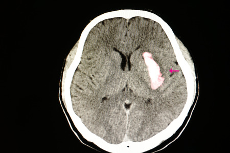 CT scan of the brain of a stroke patient with large blood clot or hematoma from intracerebral hemorrhageの写真素材