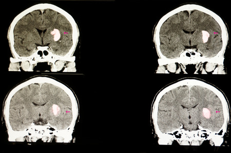 CT scan of the brain of a stroke patient with large blood clot or hematoma from intracerebral hemorrhageの写真素材