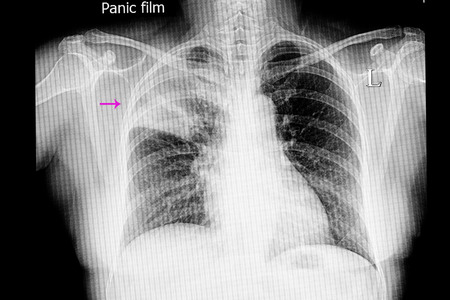 xray film of a patient with right lung lobar pneumoniaの写真素材
