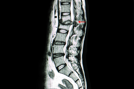 MRI scan of lumbar spines of a patient with kyphosis and back pain showing spondylodiscitis at L1, L2 levels, bulging of L3, L4 disc and spinal cannal stenosis. Diagnosis TB spines.の写真素材