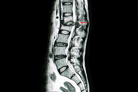 MRI scan of lumbar spines of a patient with kyphosis and back pain showing spondylodiscitis at L1, L2 levels, bulging of L3, L4 disc and spinal cannal stenosis. Diagnosis TB spines.の素材 [FY310105578737]