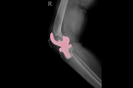 film xray of a knee of patient with total knee prosthesis replacementの写真素材