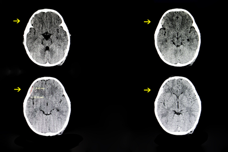CT scan of a brain of a 4 year old child with a history of crush injury (hit by a falling TV) showing a small subdural hematoma in his right frontotemporal cerebral area.の写真素材