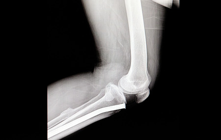 A leg xray film of a patient with an orthopedic nail in the tibiaの写真素材