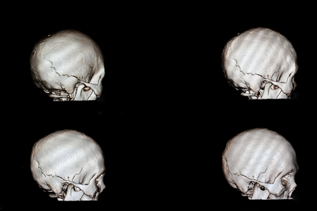 3 d rendering of a skull of a patient with head injury who had fracture occipito-temporal bone of his craniumの写真素材