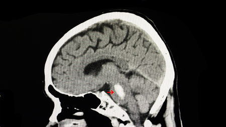 A CT scan of the brain of a patient with intracranial hemorrhage. The lesion is in the pons in this...