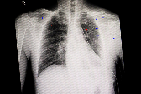 Cheat xray of a traumatic patient. Blue arrows show fracture left clavicle, scapular,  posterior ribs, and old fracture right clavicle. Red arrows show reticular infiltrations in both lungs.の写真素材