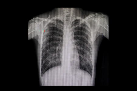 Xray film of a patient with active pulmonary tuberculosis in the right upper lung (red arrow).の写真素材