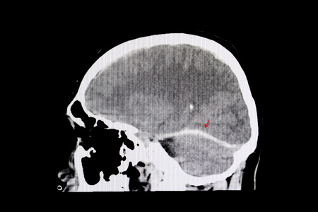 CT scan of a brain of a patient with interhemispheric hemorrhage from trauamatic brain injury (TBI).の写真素材