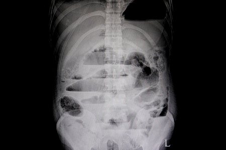 A plain abdominal upright film of a patient showing mechanical bowel obstration with internal air fluid level in loop of bowels. Step ladder pattern film.の写真素材
