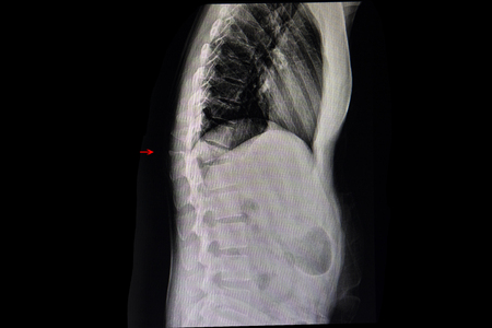 Xray film of a back of a patient who had chronic back pain showing wedge shaped compression fracture of her thoracic spine.の写真素材