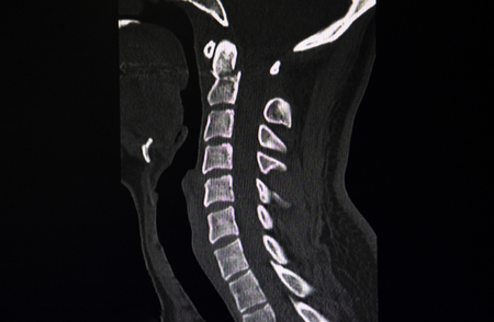 CT scan image of  fracture C2 cervical vertebrae.の写真素材
